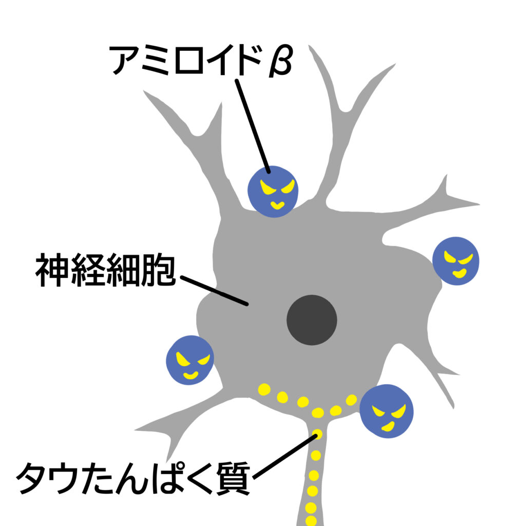 アルツハイマー型認知症の原因は、アミロイドβやタウタンパク質が脳神経細胞を破壊するためであると考えられている。